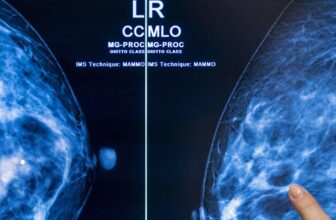 AI-assisted most cancers screening may lower radiologist workloads in half
